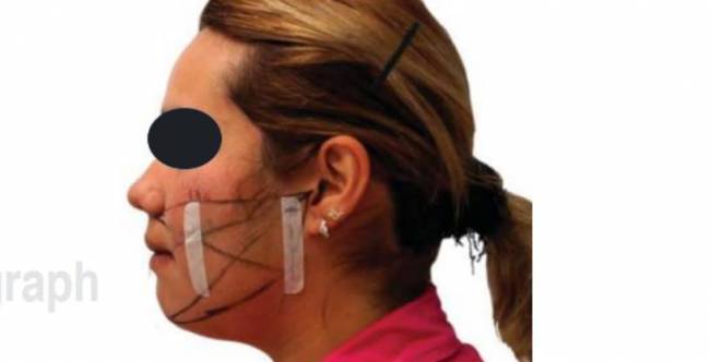 Apósito adhesivo facial para el control de la inflamación de la odontectomía del tercer molar