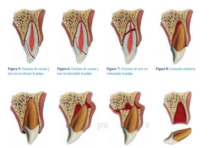 Fracturas dentales en Odontología Deportiva