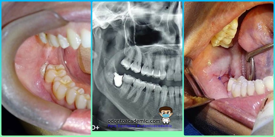 Cirugía Bucal De Tercer Molar Inferior Previamente Fracturado