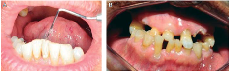Pacientes con Insuficiencia Renal crónica y su relación con caries, enfermedad periodontal y manifestaciones orales.