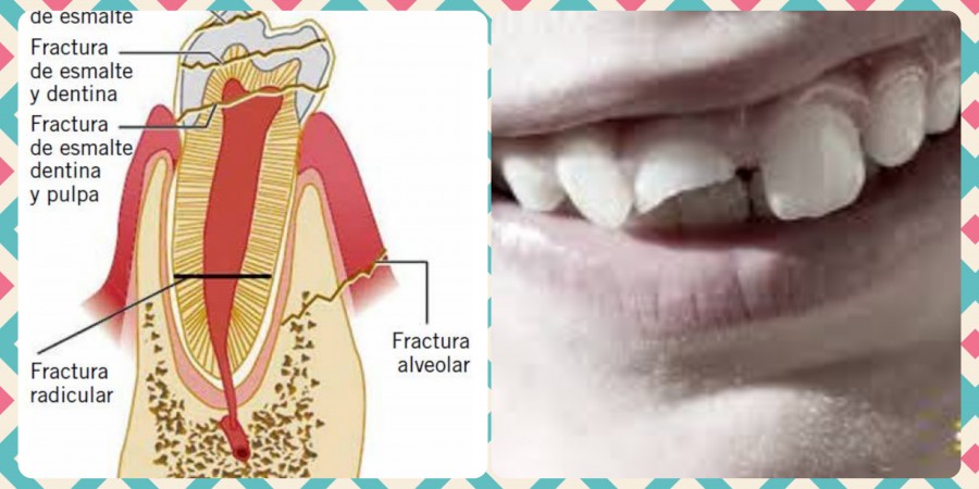 Prevención de fracturas dentales y alveolares en deportistas