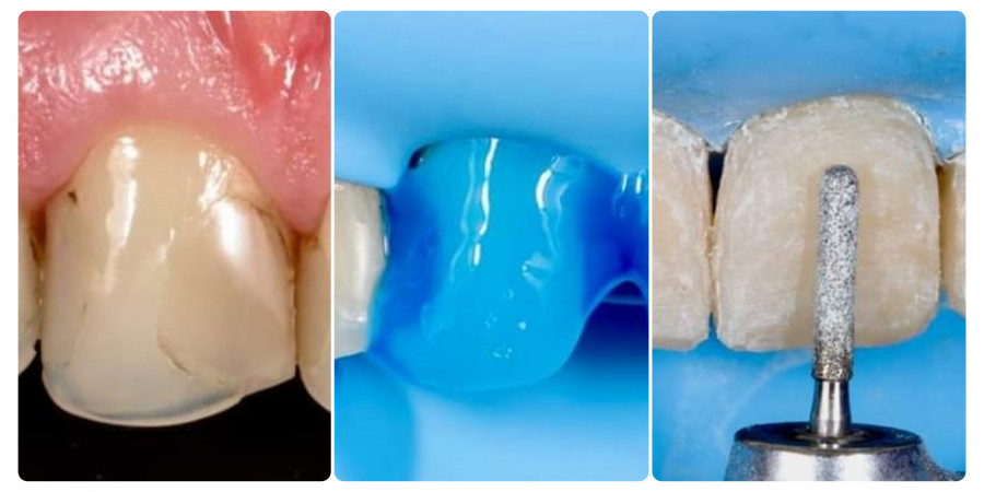 Restauracion directa con resina en dientes anteriores
