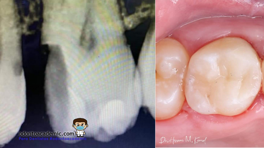 Restauración interproximal con sistema matriz ( molar superior )
