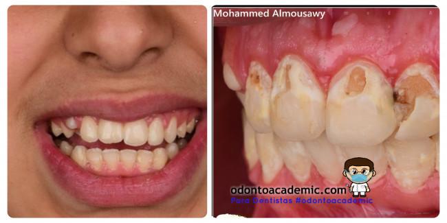 Restauraciones dentales anteriores en odontopediatría
